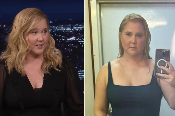 Amy Schumer gets candid about her 'puffy face' caused by hormonal disorder Cushing's syndrome