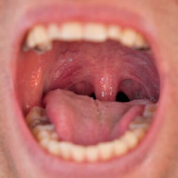 Dentist warning as dry mouth could be 'red flag' symptom of 5 serious illnesses