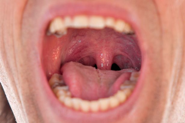 Dentist warning as dry mouth could be 'red flag' symptom of 5 serious illnesses