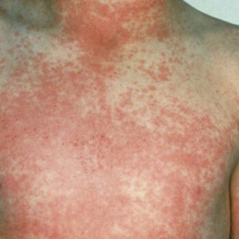 Unusual 'strawberry' symptom of scarlet fever as Victorian disease makes 'notable resurgence'