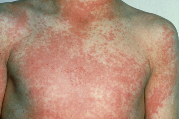 Unusual 'strawberry' symptom of scarlet fever as Victorian disease makes 'notable resurgence'