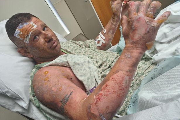 Dad-of-two ‘lucky to be alive’ after gas canister exploded in his hands