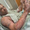 Dad-of-two ‘lucky to be alive’ after gas canister exploded in his hands