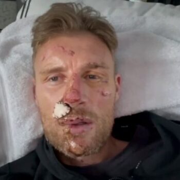 Freddie Flintoff reveals full facial injuries in tearful home video after Top Gear crash