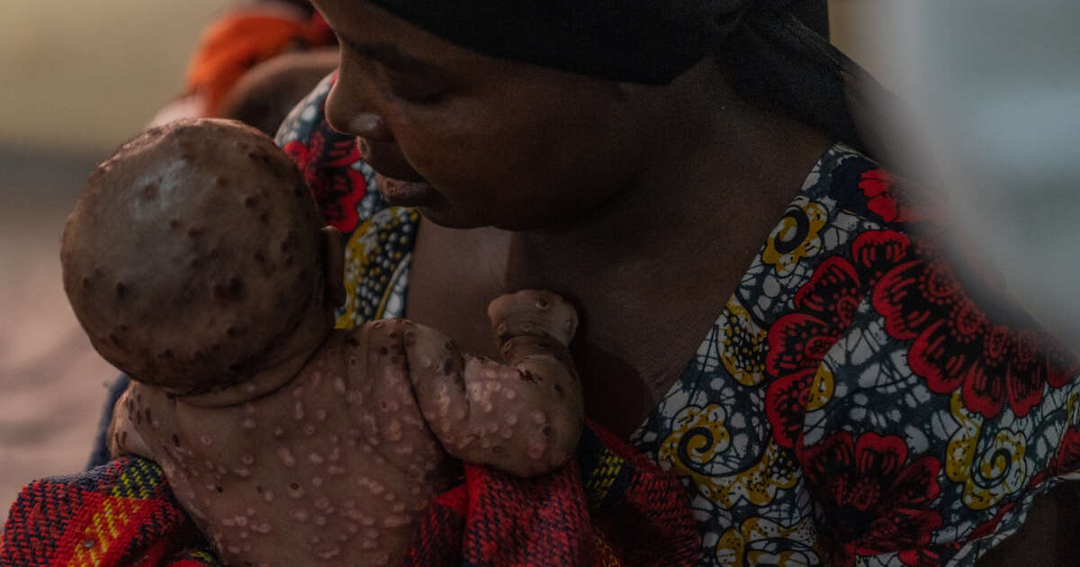 En Afrique, l’inquiétude autour des cas de mpox touchant les enfants