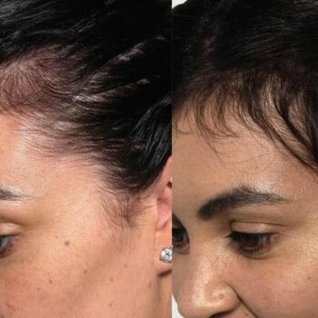 '3 weeks in and I'm noticing a change' – scalp serum praised for giving regrowth to sparse patches