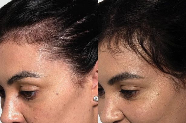 '3 weeks in and I'm noticing a change' – scalp serum praised for giving regrowth to sparse patches