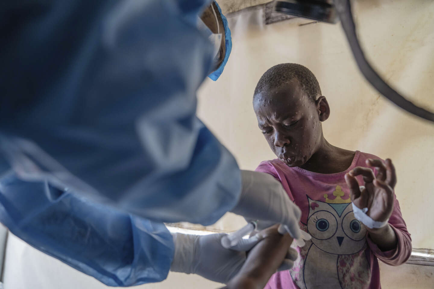 Contre la mpox, l’urgence vaccinale pour l’Afrique