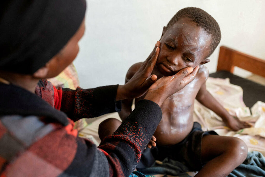 Face à la mpox, l’Unicef lance un appel d’offres pour obtenir des vaccins