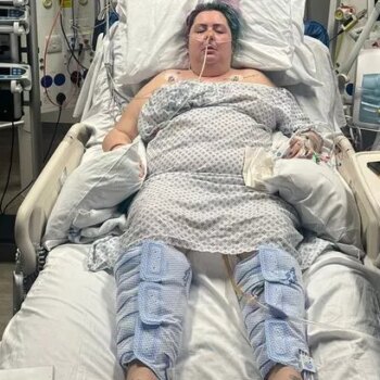 'I thought I was going to die when gastric balloon got stuck in my intestine'