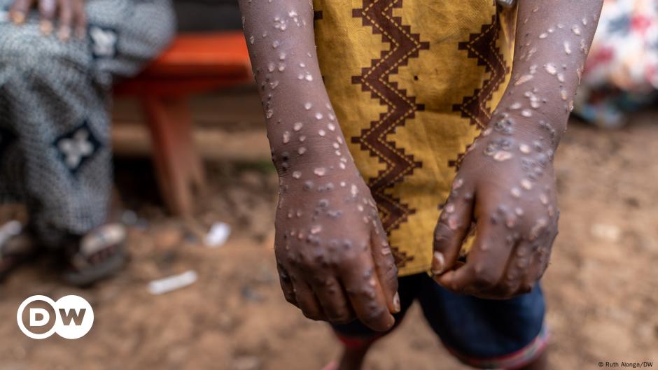 Kongos Flüchtlingslager und der Kampf gegen Mpox