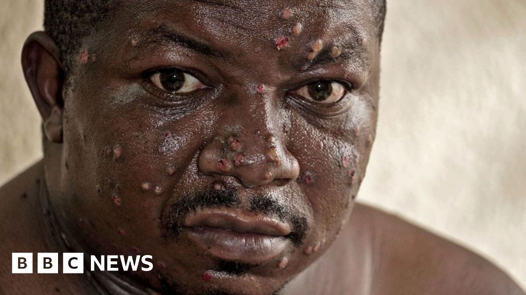 'My throat was so painful I couldn’t sleep' - on the mpox frontline