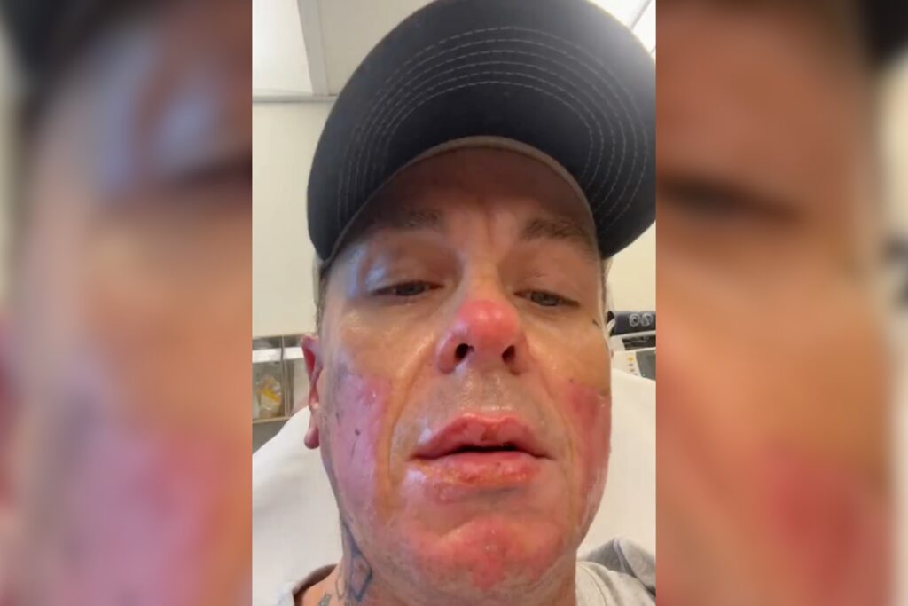 Slipknot’s Sid Wilson details gruesome injuries from bonfire explosion: ‘My face is basically melted’