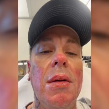 Slipknot’s Sid Wilson details gruesome injuries from bonfire explosion: ‘My face is basically melted’