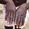 Three more cases of Mpox detected outside of Africa - as new details of Swedish patient with deadly variant emerges