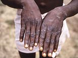 Three more cases of Mpox detected outside of Africa - as new details of Swedish patient with deadly variant emerges