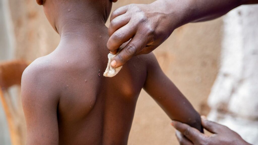 Mpox-Virus: Unicef bringt Notfallausschreibung für Mpox-Impfstoff auf den Weg