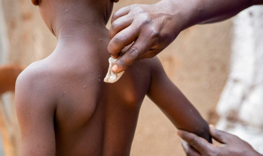 Mpox-Virus: Unicef bringt Notfallausschreibung für Mpox-Impfstoff auf den Weg