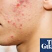 Acne rates in UK adolescents and young adults among highest in the world