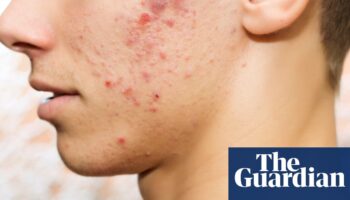 Acne rates in UK adolescents and young adults among highest in the world