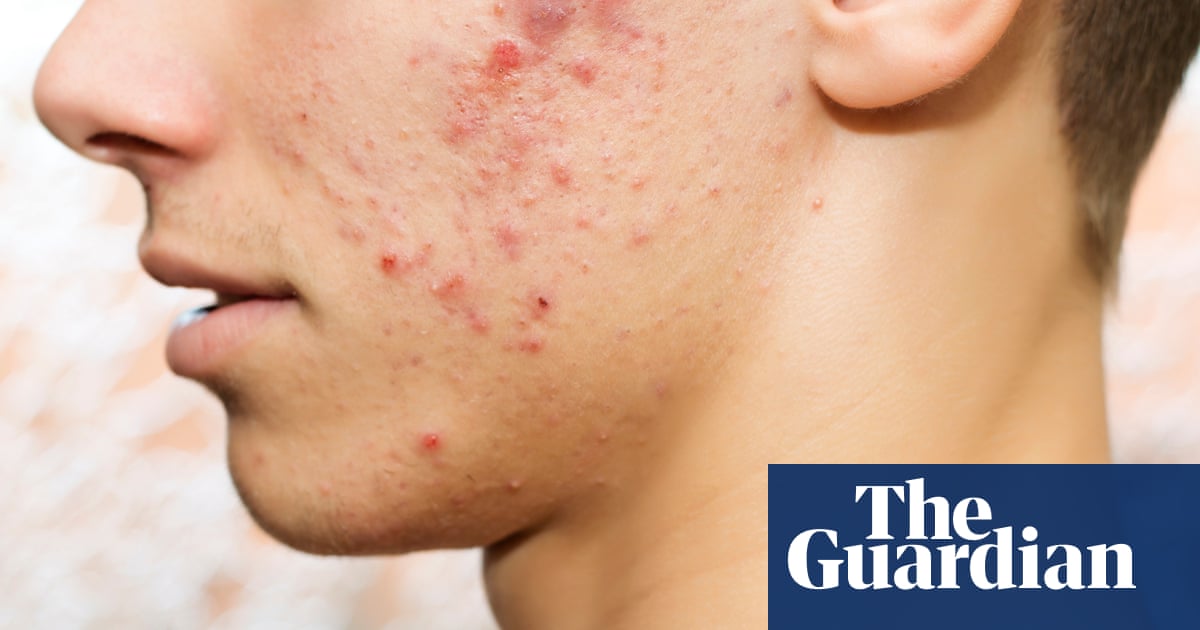 Acne rates in UK adolescents and young adults among highest in the world