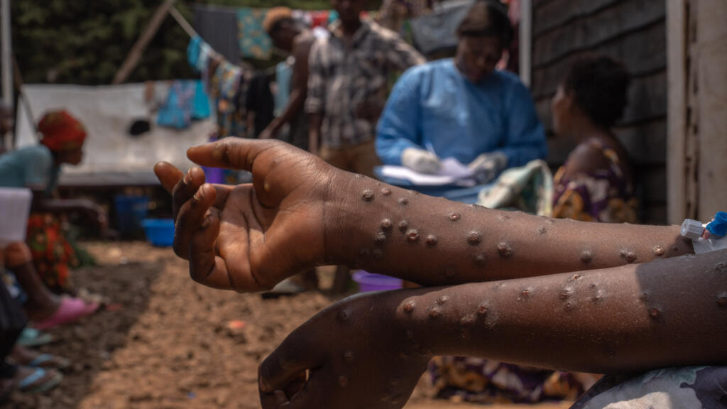 Mpox : épicentre de l'épidémie, la RD Congo reçoit ses premiers vaccins