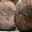 Receding hairlines be gone! The 'lunch hour hair transplant' promises to restore thinning locks - but would YOU try it?