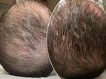 Receding hairlines be gone! The 'lunch hour hair transplant' promises to restore thinning locks - but would YOU try it?