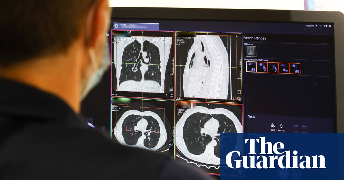 UK can expect ‘tsunami of missed cancers’ in wake of pandemic, experts say