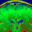 Manipulationsskandal erschüttert Alzheimer- und Parkinsonforschung