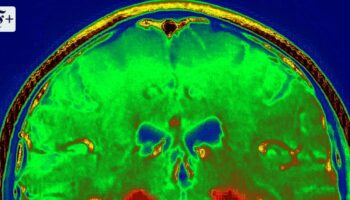 Manipulationsskandal erschüttert Alzheimer- und Parkinsonforschung