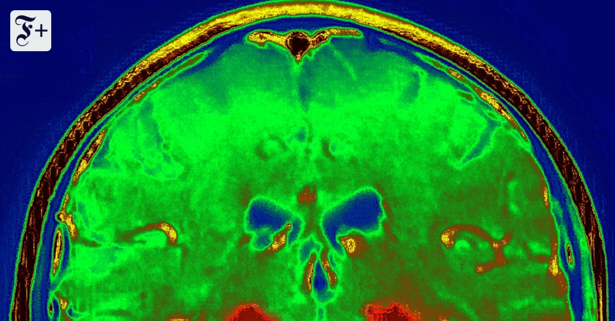 Manipulationsskandal erschüttert Alzheimer- und Parkinsonforschung