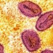 RKI meldet ersten Nachweis von neuer Mpox-Variante in Deutschland