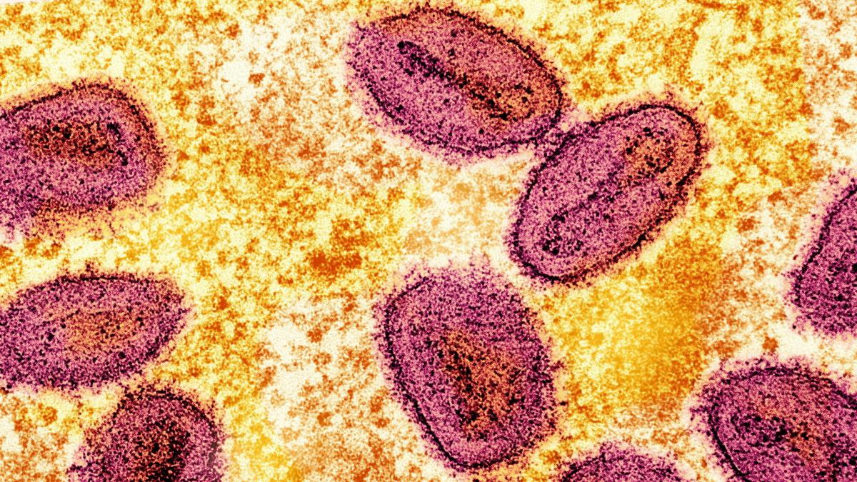 RKI meldet ersten Nachweis von neuer Mpox-Variante in Deutschland