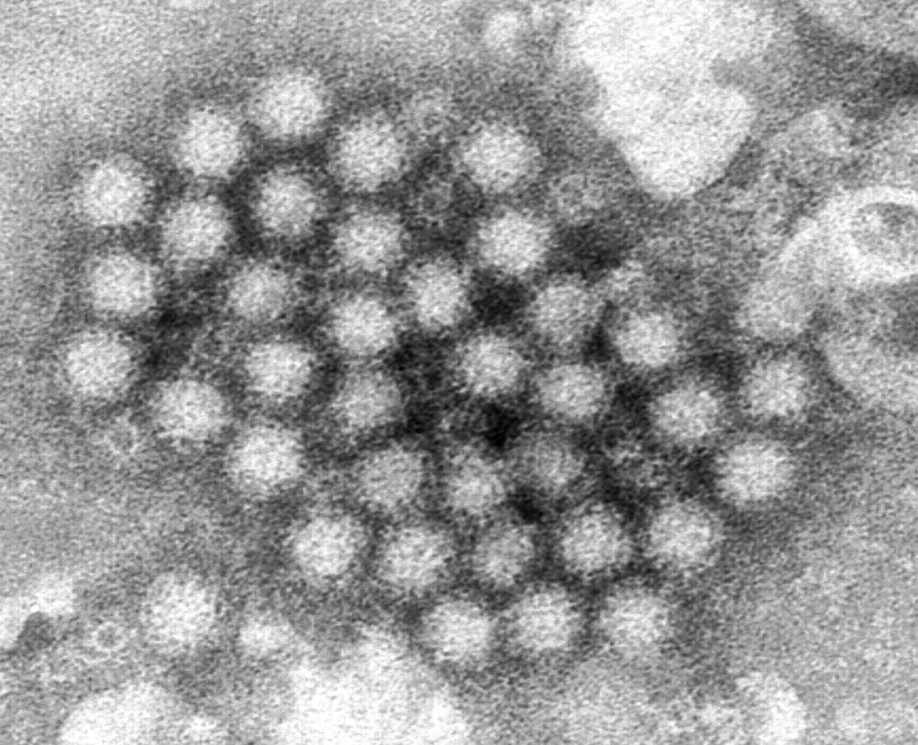 What would the norovirus vaccines mean for NHS pressure and wait times?