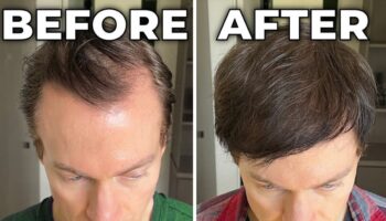 Millionaire biohacker, 47, reveals how he managed to ‘reverse his hair loss and greying by 70 per cent’