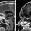 Scan of Doreen Adams head before (left) and after (right) an operation by consultant neurosurgeon, Anastasios Giamouriadis, to remove a brain tumour through her eyebrow. Pic: NHS Grampian