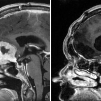 Scan of Doreen Adams head before (left) and after (right) an operation by consultant neurosurgeon, Anastasios Giamouriadis, to remove a brain tumour through her eyebrow. Pic: NHS Grampian