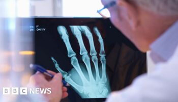 AI to help doctors spot broken bones on X-rays