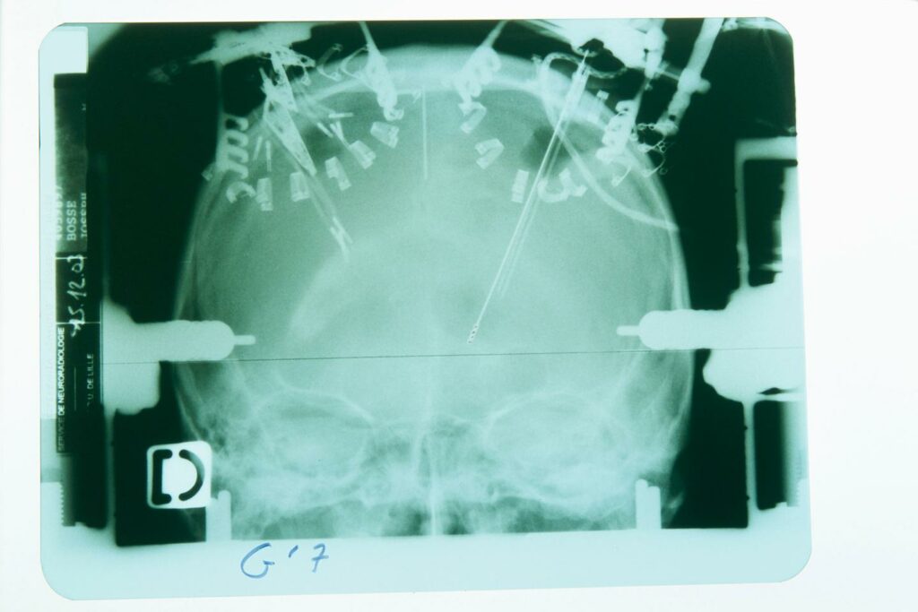 Du soin à la surveillance du cerveau : sept défis pour les neurotechnologies