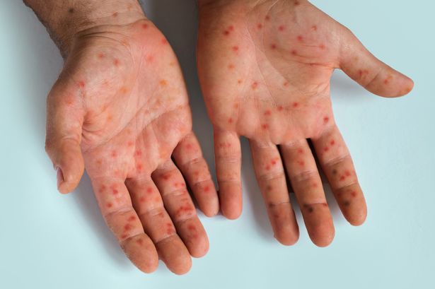 How contagious is Mpox Clade 1? Outbreak of 'killer' disease strain confirmed in London