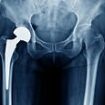 Poisoned by a hip replacement: Fears thousands may be at risk as woman claims implant op wrecked her life