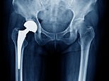 Poisoned by a hip replacement: Fears thousands may be at risk as woman claims implant op wrecked her life