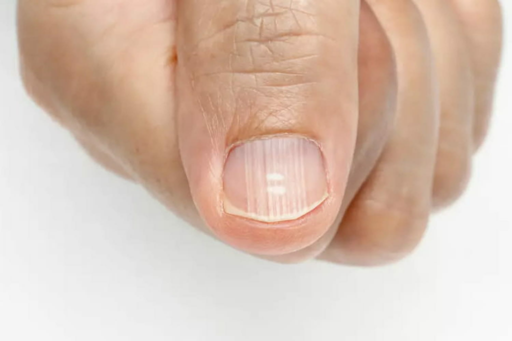 Ce que les ongles striés disent sur la santé et le bon fonctionnement du corps