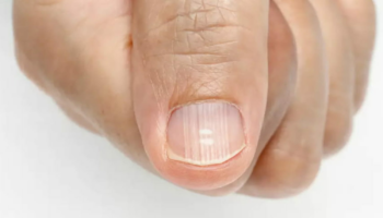 Ce que les ongles striés disent sur la santé et le bon fonctionnement du corps