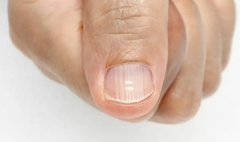 Ce que les ongles striés disent sur la santé et le bon fonctionnement du corps