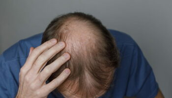 Ce traitement contre la perte de cheveux chez l'homme fonctionne mieux que les autres