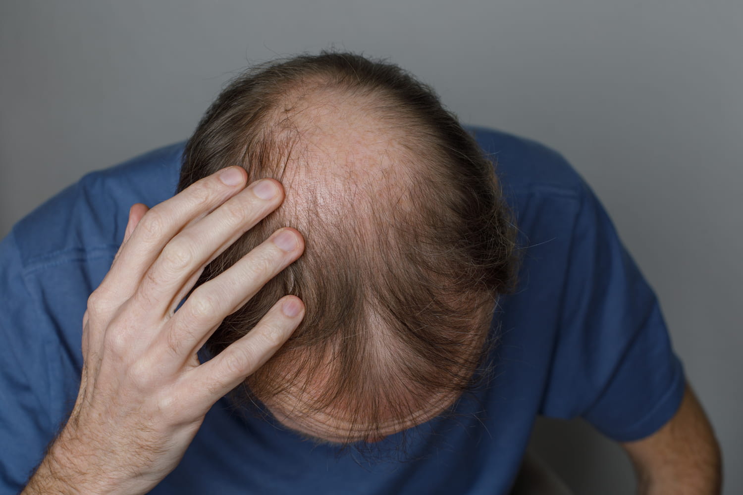 Ce traitement contre la perte de cheveux chez l'homme fonctionne mieux que les autres