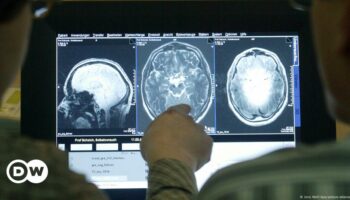 Alzheimer Medikament: EMA gibt grünes Licht für Lecanemab