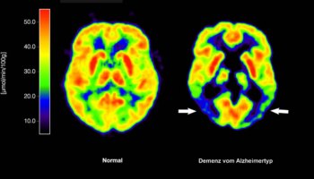 Alzheimer-Medikament Lecanemab: "Das Medikament kann den Krankheitsverlauf ein knappes halbes Jahr aufhalten"